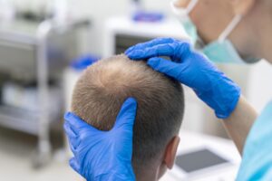 Diagnóstico de alopecia com tricologista