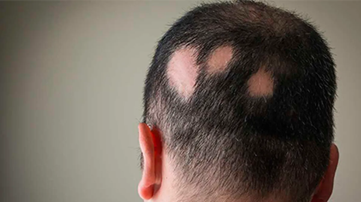 Imagem de um homem com falhas no cabelo, que são o sinal da alopecia areata. Que agora tem novo tratamento disponivel.