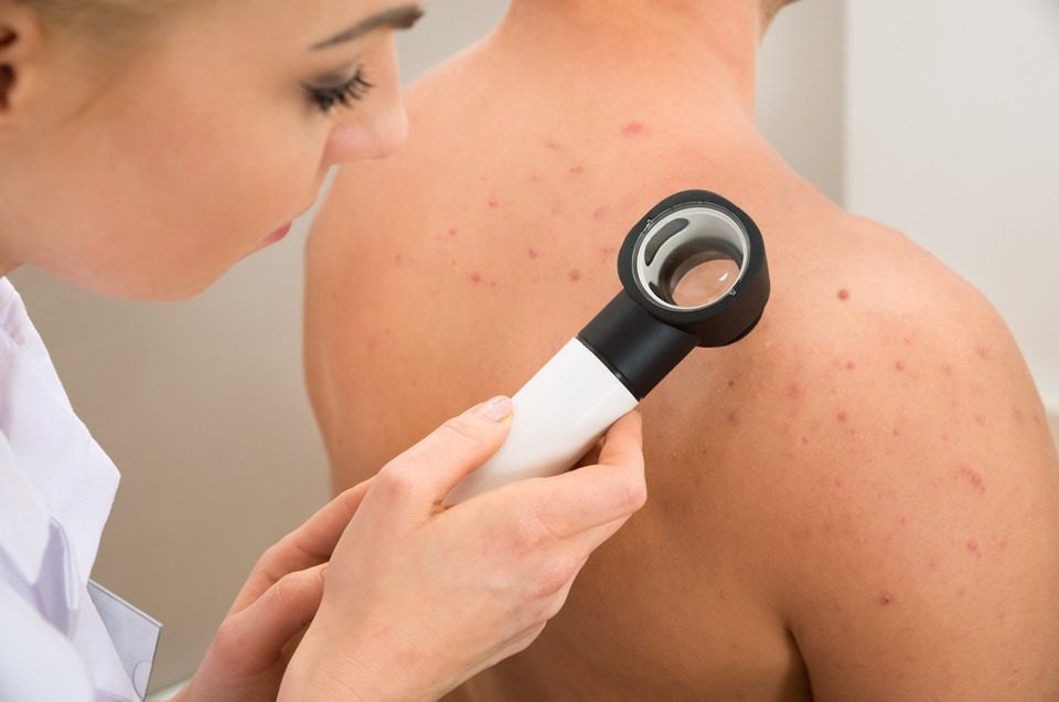 Medica realiza dermatoscopia em um sinal com suspeita de cancer de pele